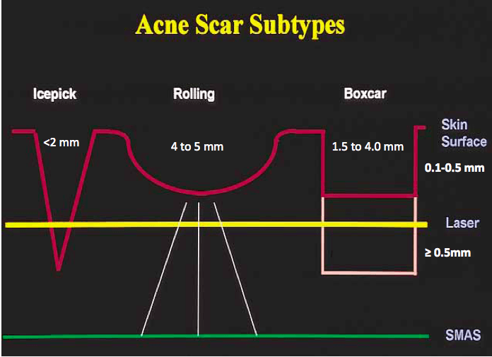 Acne Scar Subtypes