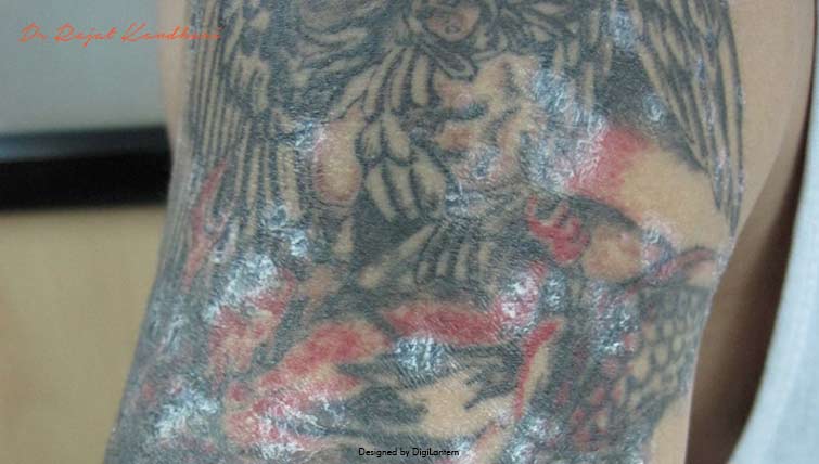 Tattoo Allergies – What Should I Be Worried About Before Getting Inked?