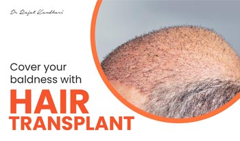 Cover your Baldness with Hair Transplant!