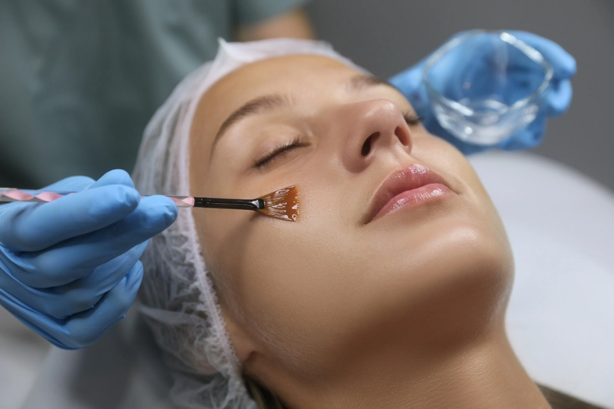 Chemical peel