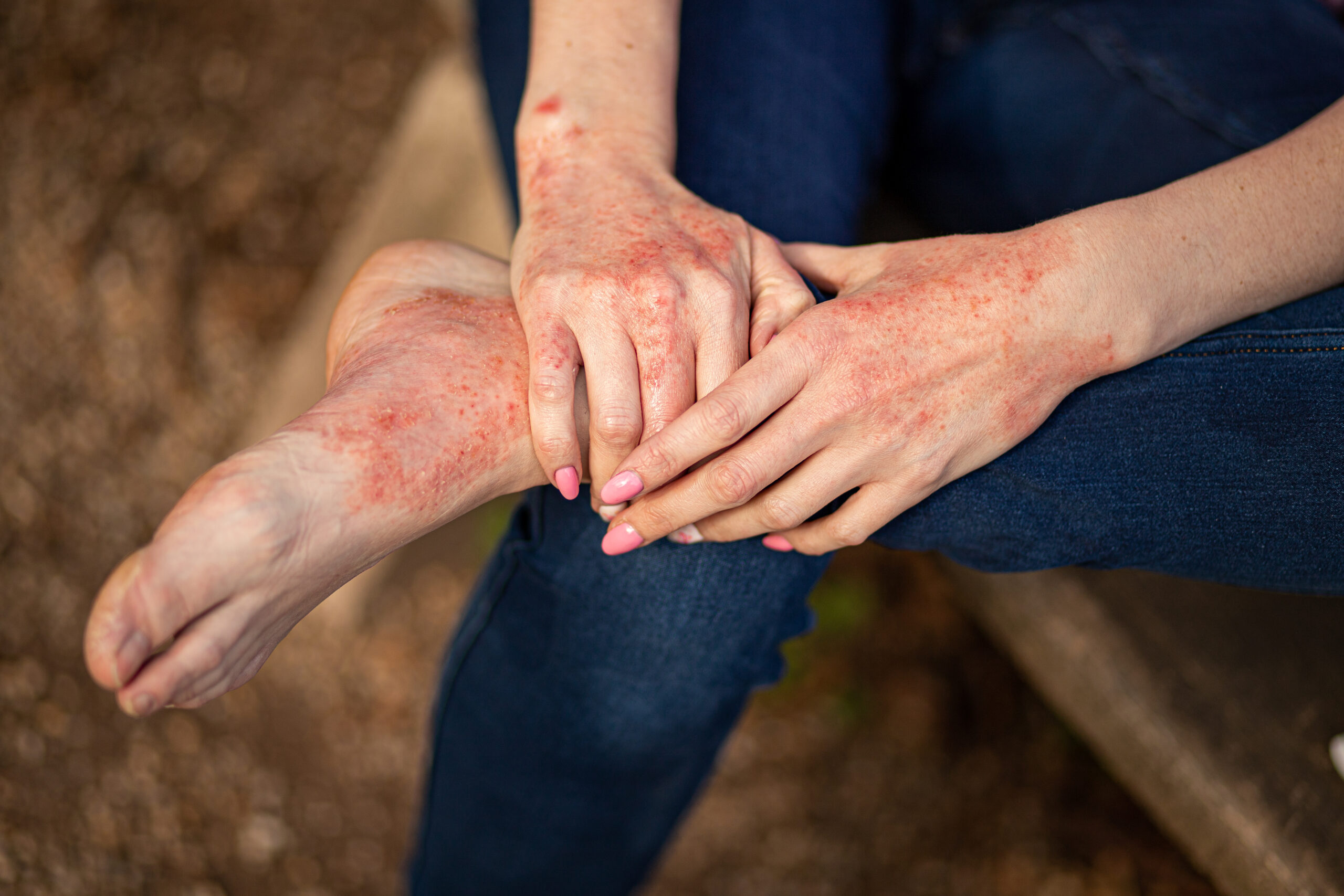 fungal skin infection delhi