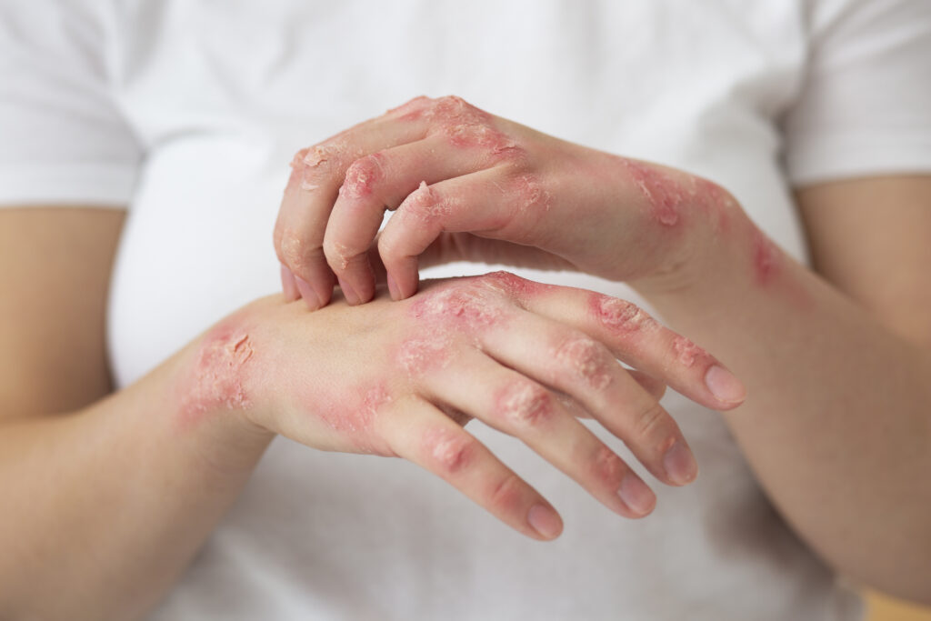 Hands patient suffering from psoriasis