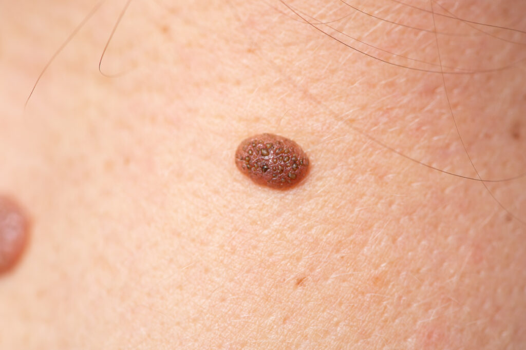 Close up shot of human skin and mole