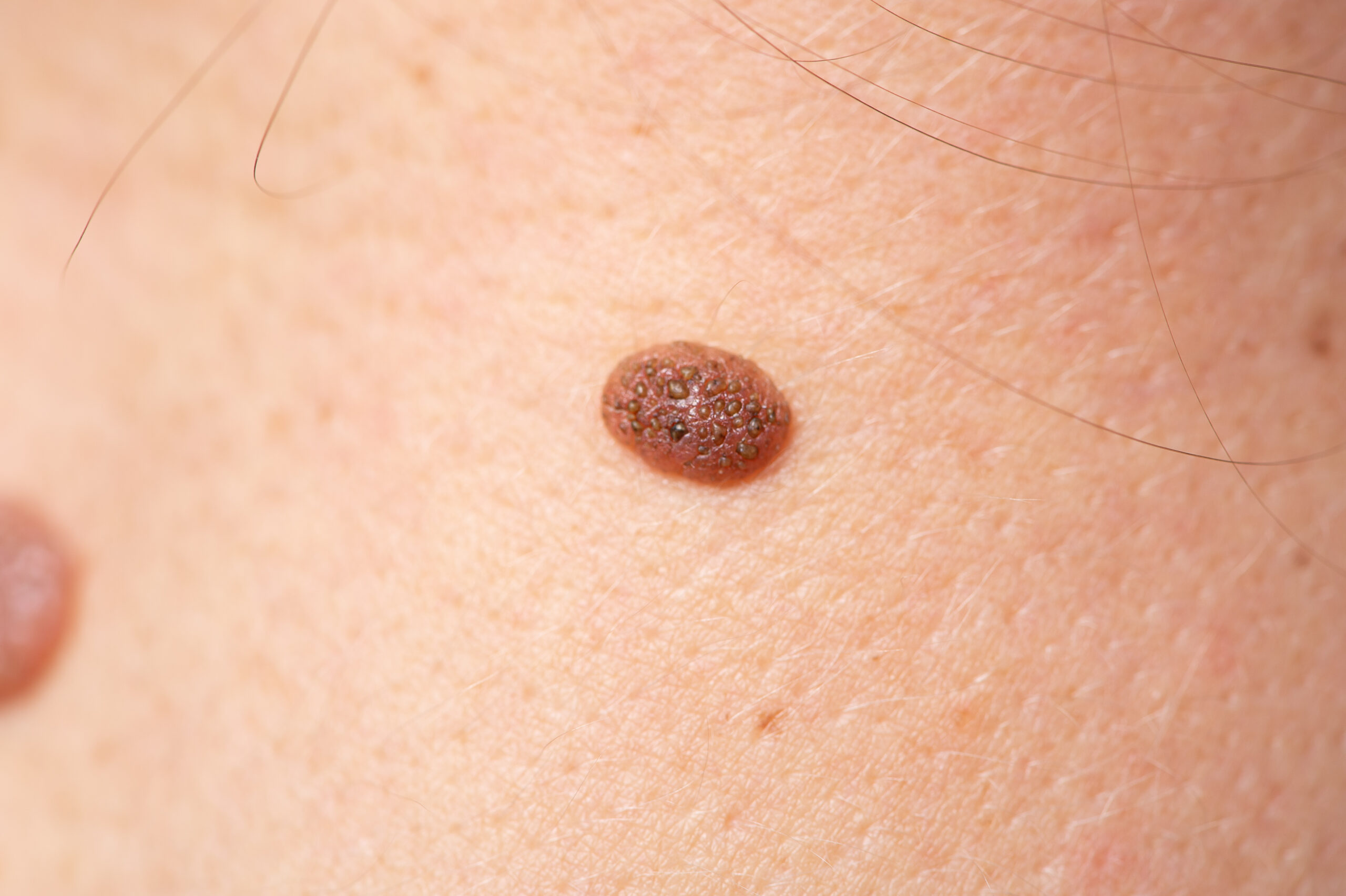 Close up shot of human skin and mole