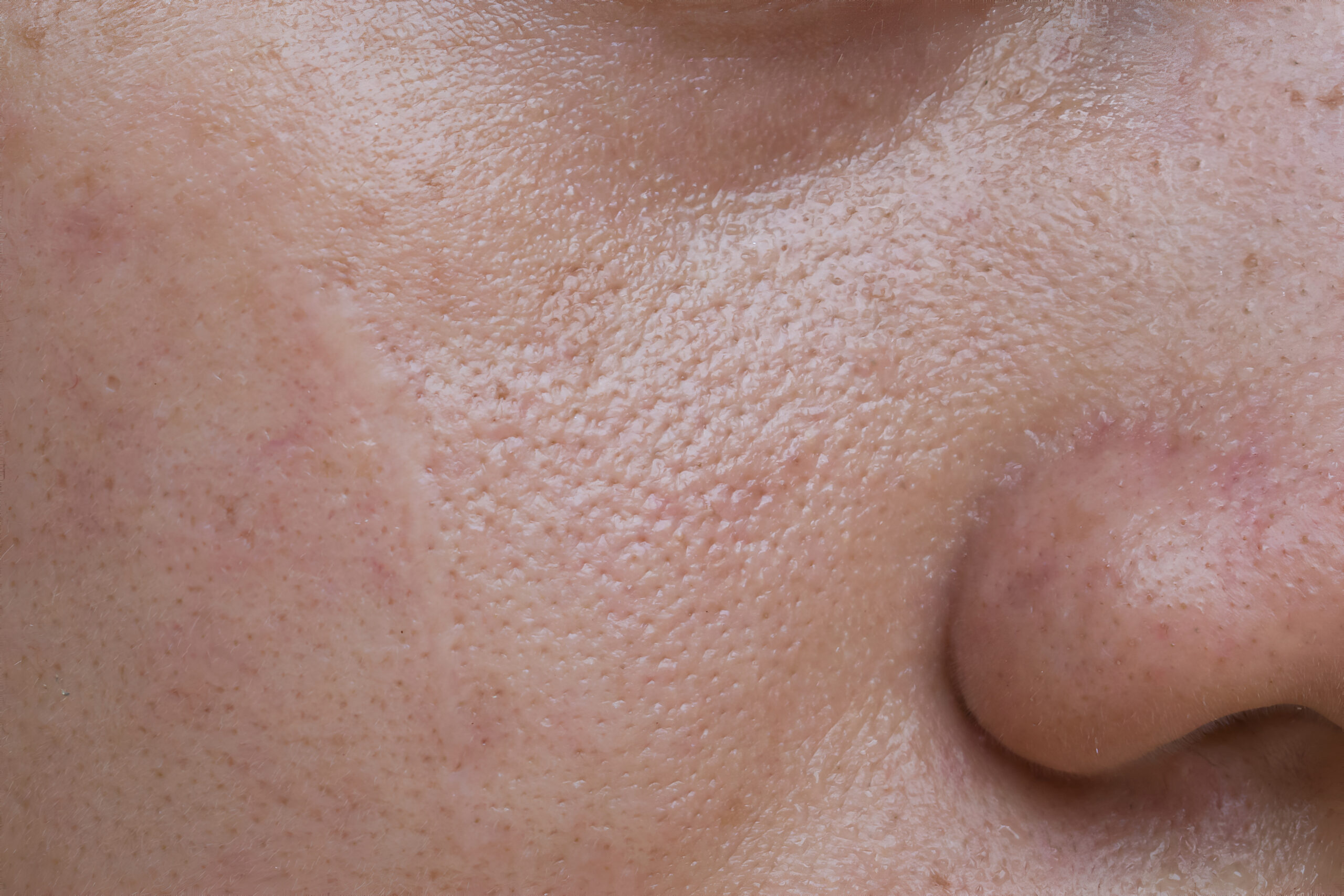 Fair skin with wide pores in face of Asian, Myanmar or Korean woman.