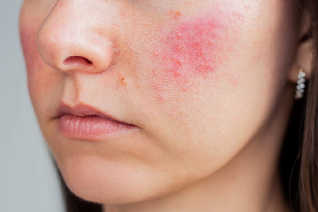 Young woman suffering from rosacea her face acute stage skin chronic disease