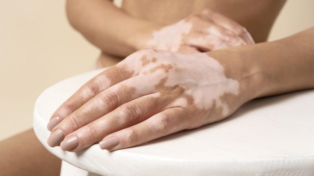 vitiligo treatment